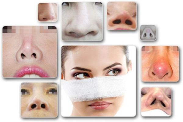 Những người gặp phải các biến chứng không mong muốn sau khi nâng mũi như da mũi bóng đỏ, lệch sóng, ...