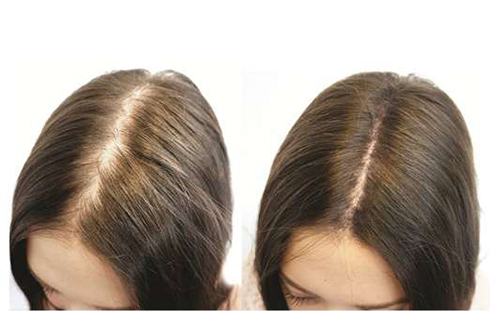 Tăng cường phục hồi các nang tóc yếu, thúc đẩy quá trình tái tạo nang tóc mới Tăng cường phục hồi các nang tóc yếu, thúc đẩy quá trình tái tạo nang tóc mới