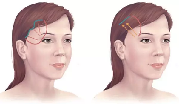 Hình ảnh quá trình mô phỏng phẩu thuật căng da trán thái dương Hình ảnh quá trình mô phỏng phẩu thuật căng da trán thái dương