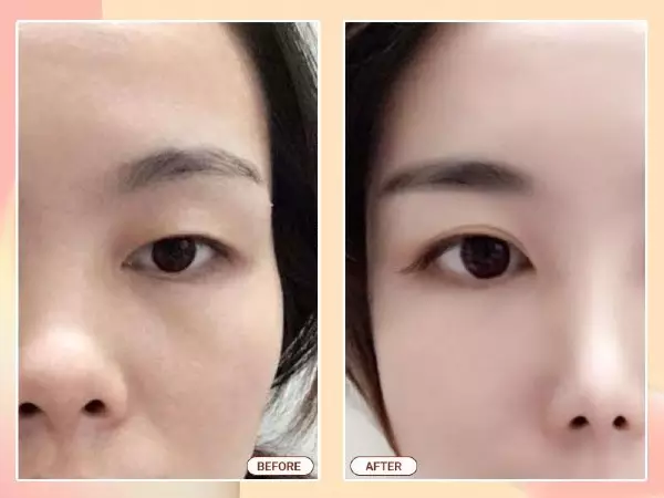 Đường khâu nét siêu mảnh, đảm bảo tính thẩm mỹ, loại bỏ hoàn toàn da chùng, mỡ thừa mi trên