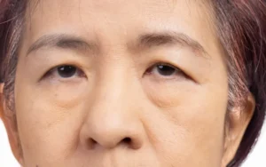 Khách hàng trên 30 tuổi, phần da dưới mi cung chân mày bị chùng nhão, chảy xệ, sụp mí 