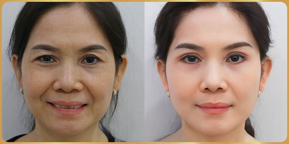 Không rạch da, không cắt mô tổ chức dưới da, không ảnh hưởng đến dây thần kinh cảm giác Không rạch da, không cắt mô tổ chức dưới da, không ảnh hưởng đến dây thần kinh cảm giác