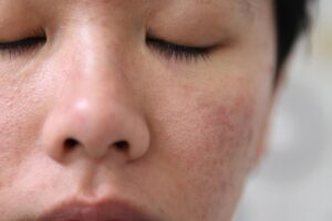 Da khô sần, lỗ chân lông to, nám sạm vì không chăm da Da khô sần, lỗ chân lông to, nám sạm vì không chăm da