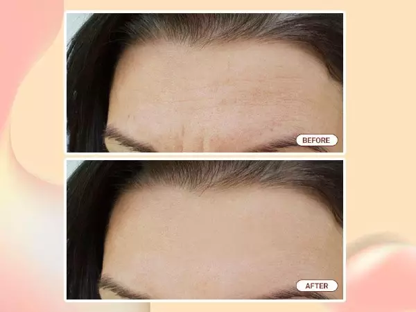 Kích thích tăng sinh collagen và elastin, giúp cho làn da căng bóng và đầy đặn hơn. Kích thích tăng sinh collagen và elastin, giúp cho làn da căng bóng và đầy đặn hơn.