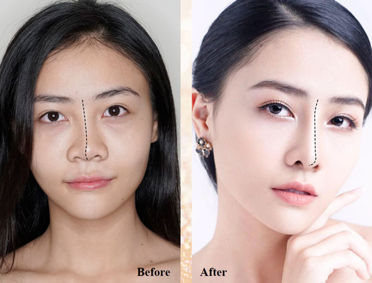 Với trường hợp mũi hỏng ở mức độ nhẹ như lộ sóng, lệch sóng,… thì có thể chỉnh sửa lại dáng mũi đẹp gần như mới. Với trường hợp mũi hỏng ở mức độ nhẹ như lộ sóng, lệch sóng,… thì có thể chỉnh sửa lại dáng mũi đẹp gần như mới.