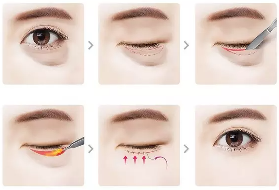 Hình ảnh mô phỏng quá trình lấy bọng mỡ mi dưới Hình ảnh mô phỏng quá trình lấy bọng mỡ mi dưới
