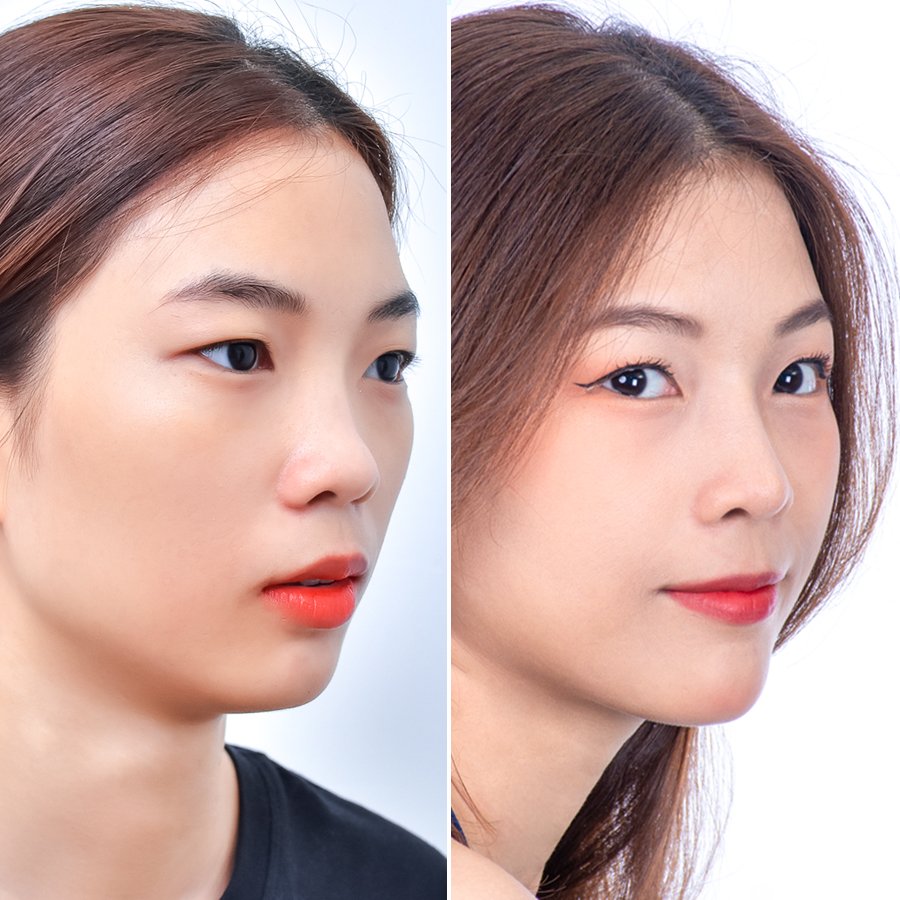 Nâng cao sống mũi, cải thiện các khuyết điểm ở đầu mũi, xương mũi, cánh mũi.