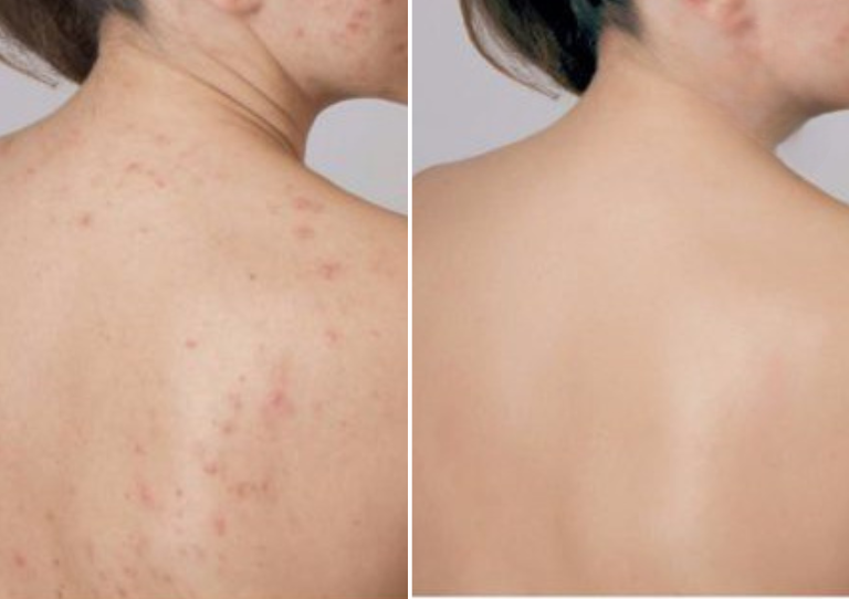 Loại bỏ tình trạng viêm hơn 95%, khống chế những biểu hiện do viêm nang lông gây ra mụn.