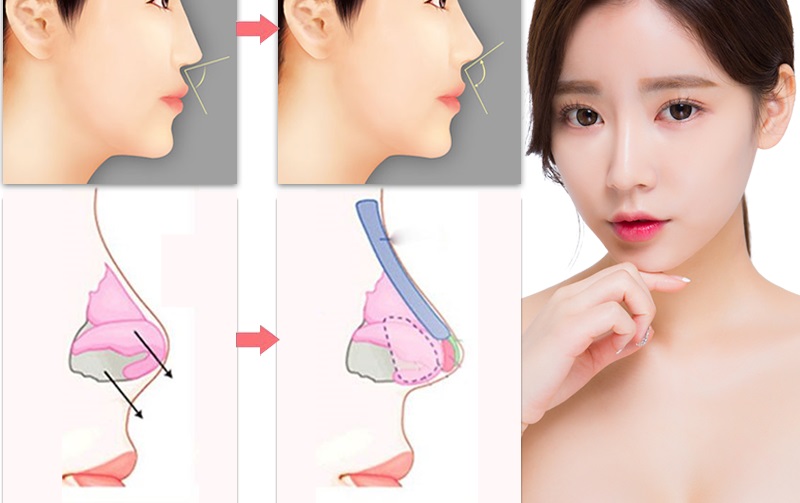 Hình ảnh mô phỏng phẫu thuật nâng mũi 