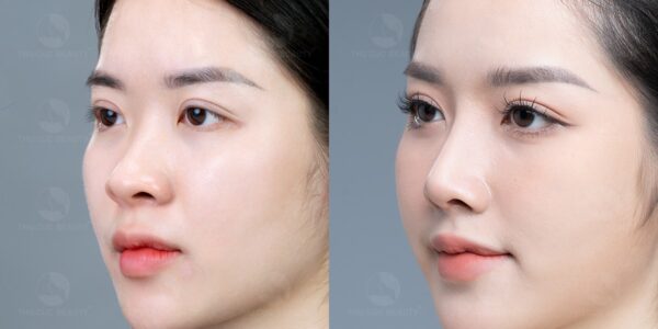 Tạo dáng mũi đẹp tự nhiên, chuẩn tỷ lệ vàng, hài hòa với gương mặt.
