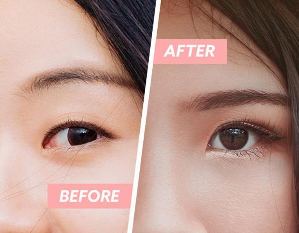 Ít xâm lấn, hạn chế để lại sẹo, không ảnh hưởng đến thị lực, thời gian thực hiện nhanh chóng, kết quả duy trì lâu dài