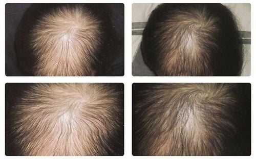 Tiếp xúc nhiều với hoá chất, phụ nữ sau sinh, hậu Covid, stress, căng thẳng, thức khuya, thay đổi nội tiết tố Tiếp xúc nhiều với hoá chất, phụ nữ sau sinh, hậu Covid, stress, căng thẳng, thức khuya, thay đổi nội tiết tố