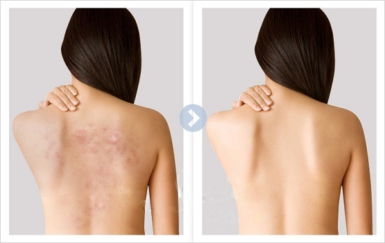 Hình ảnh trước và sau khi trị thâm lưng Hình ảnh trước và sau khi trị thâm lưng