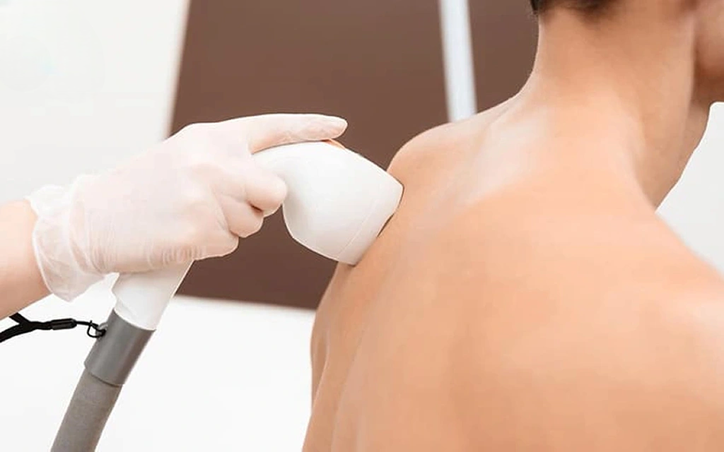Áp dụng laser, IPL hoặc peel da để cải thiện viêm nang lông.