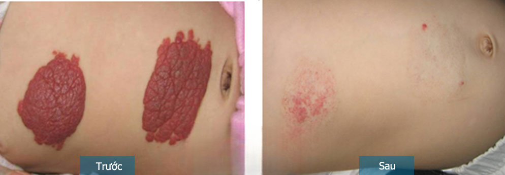 Xóa vết u mạch hơn 90% sau 1 liệu trình, ngăn ngừa tình trạng tái phát sau điều trị Xóa vết u mạch hơn 90% sau 1 liệu trình, ngăn ngừa tình trạng tái phát sau điều trị