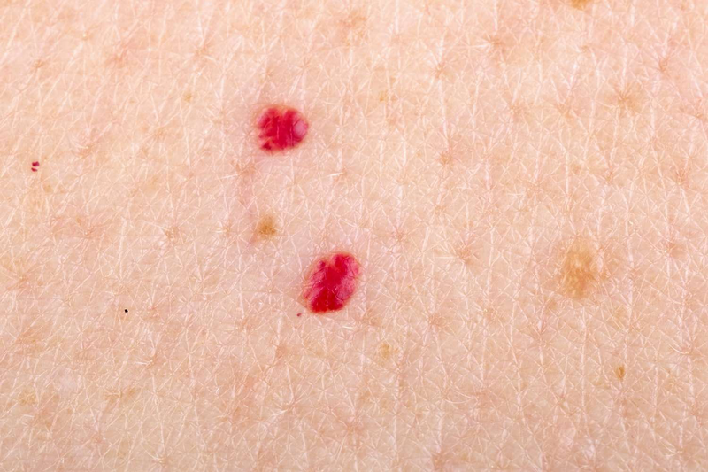Do nhiễm virus gây u nhú trên người, mất kiểm soát điều hòa tăng sinh tế bào nội mạch của mạch Do nhiễm virus gây u nhú trên người, mất kiểm soát điều hòa tăng sinh tế bào nội mạch của mạch