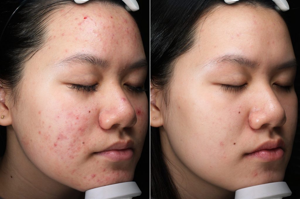 Trị sẹo thâm triệt để, làn da trở nên căng mịn. trắng sáng hơn, hỗ trợ thu nhỏ lỗ chân lông, kiểm soát tuyến bã nhờn Trị sẹo thâm triệt để, làn da trở nên căng mịn. trắng sáng hơn, hỗ trợ thu nhỏ lỗ chân lông, kiểm soát tuyến bã nhờn